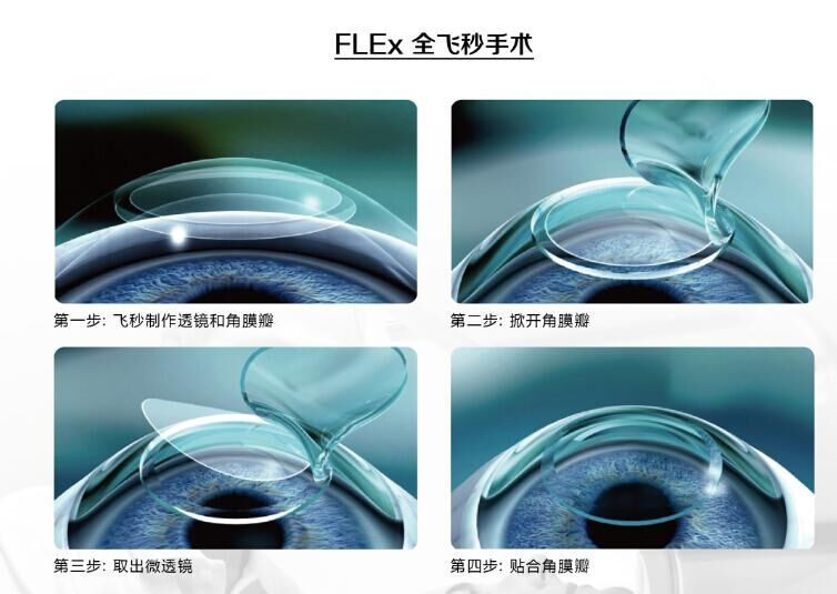 蔡司全飛秒、蔡司半飛秒近視手術(shù)與蔡司全飛秒flex手術(shù)