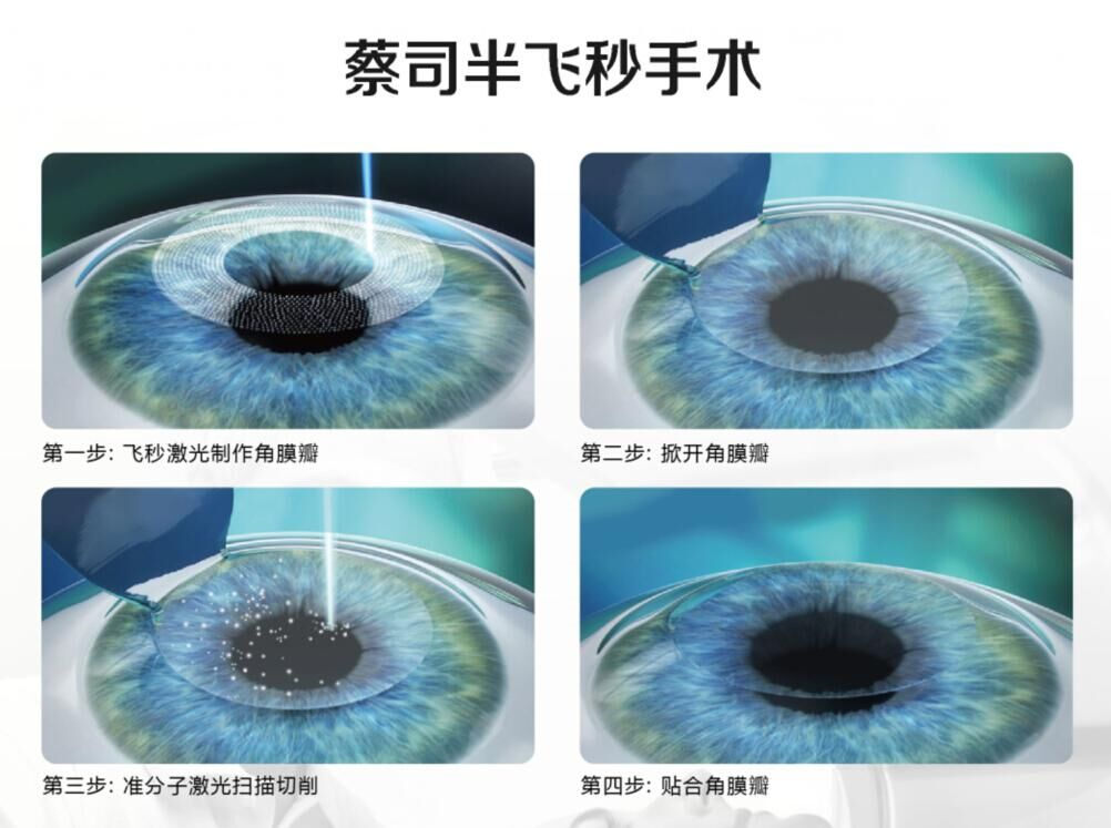 TransPRK手術(shù)與蔡司全飛秒手術(shù)、半飛秒手術(shù)有什么區(qū)別?
