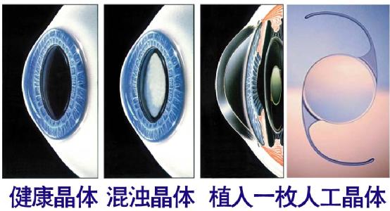 超聲乳化手術(shù)白內(nèi)障危險嗎？