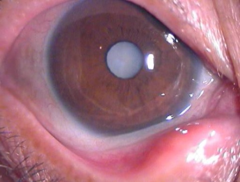 別讓人笑話你沒白內(nèi)障眼病常識