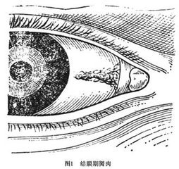 黑眼睛前面多長(zhǎng)出一塊白肉怎么辦?