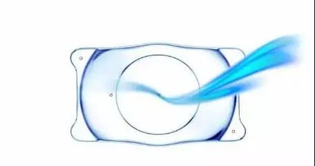 暑期摘鏡總動員:不用激光的近視眼矯正手術