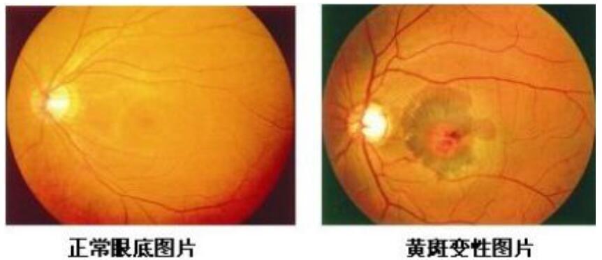 知道嗎？熬夜多了，你的眼睛也就“黃了”  很多年輕人為了