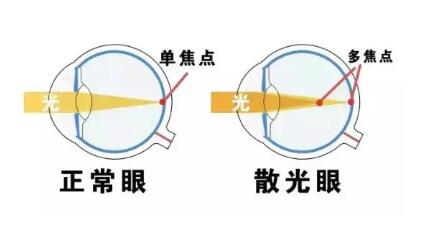 近視和散光，手術(shù)能同時(shí)矯正嗎？