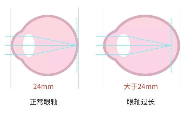 眼科醫(yī)生解密:哪些行為近視度數(shù)增長(zhǎng)快